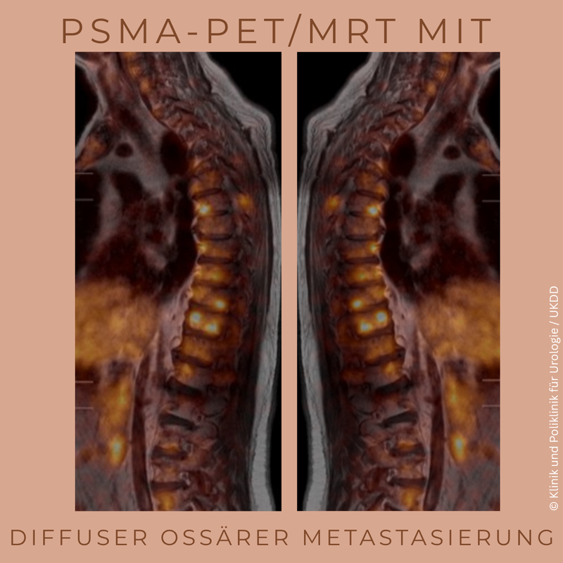 Europäischer Prostatatag 2026: Neue Wege in der Therapie des Prostatakarzinoms