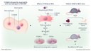 MDS Therapy: Dresden Team Demonstrates Tasquinimod’s Potential for Improved Blood Formation and Treatment of Bone Damage