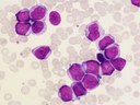 Personalized therapies for leukemia: Clinical trial from Dresden and Kiel investigates innovative medication after stem cell transplantation