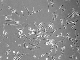 Frisch isolierte Glioblastomzellen eines Patienten in der Zellkultur (400-fache Vergrößerung). © Prof. Temme, Uniklinikum Dresden. © Prof. Temme, Uniklinikum Dresden