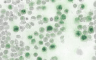 Knochenmarkausstrich eines AML-Patienten. Die neu entwickelte Analysesoftware erkennt eine bestimmte genetische Mutation anhand äußerer Zellmerkmale (dunkelgrüne Färbung). © MK1/Uniklinikum Dresden
