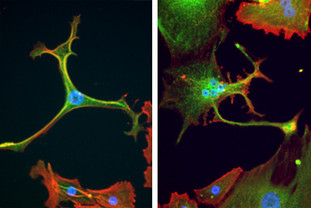 Im Labor kultivierte Zellen einer Sarkomkrebszelllinie. Quelle: Charles S. Umbaugh, Fröhling Lab/NCT Heidelberg